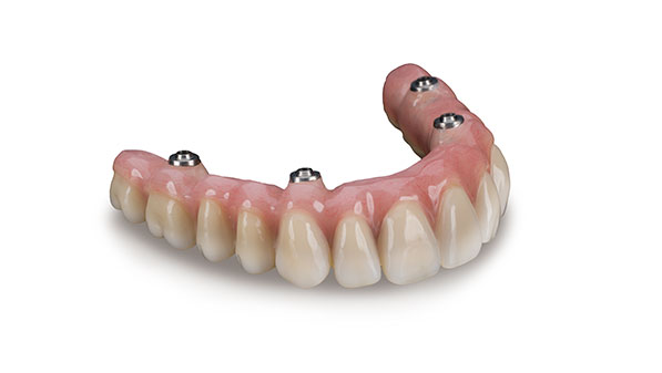 Full Zirconia Bridgework