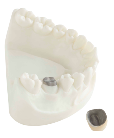 Crown and Bridgework - Non Metal - Post and Core