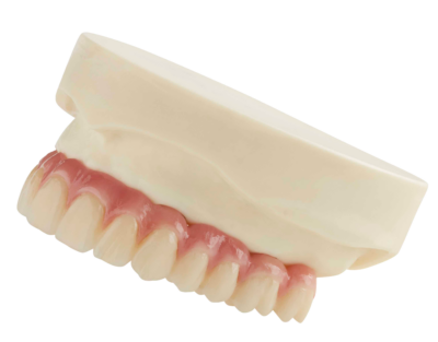 overdentures on an angle