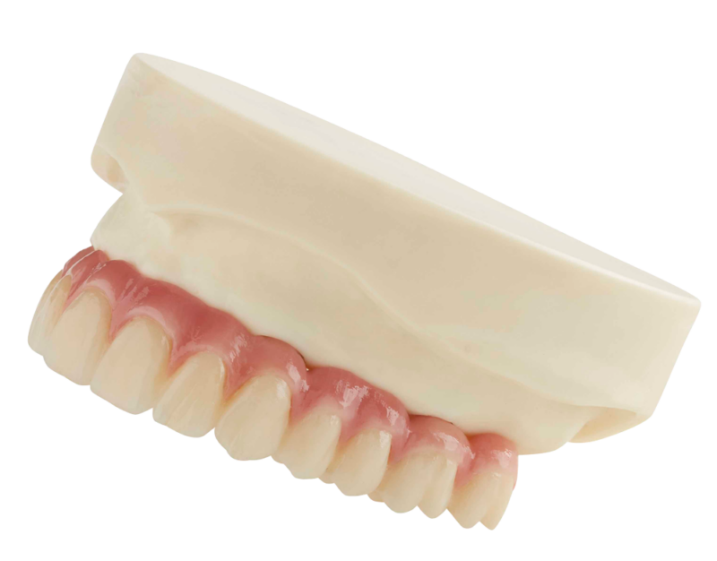 overdentures on an angle